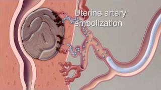 Fibroid Treatment Options  Mayo Clinic [upl. by Eneluj]