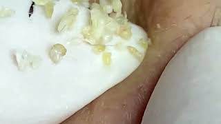 Big Cystic Acne Extraction Blackheads Milia Whiteheads Removal Pimple Popping Compilation 10007 [upl. by Addam]