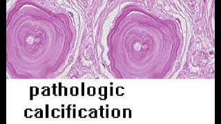 PATHOLOGIC CALCIFICATION [upl. by Nnylear]