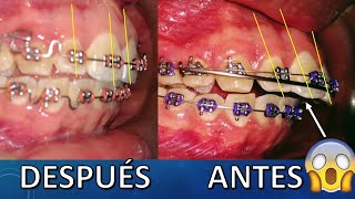 ¿Como mejorar dientes proinclinados sin la extracción de dientes premolares en algunos casos😎✌ [upl. by Nayllij463]