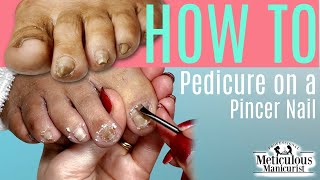 👣HOW TO DO A PEDICURE on a Pincer Toenail👣 [upl. by Iretak]