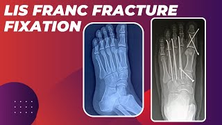 LISFRANC FRACTURE FIXATION IN A YOUNG MALE ASSOCIATED WITH MULTIPLE METATARSAL FRACTURES [upl. by Pirri]