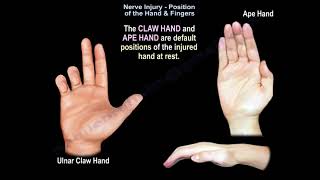 Nerve Injury Position of the Hand amp Fingers  Everything You Need To Know  Dr Nabil Ebraheim [upl. by Aihseuqal]