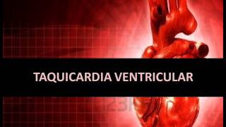 Arritmias cardíacas  Taquicardia ventricular [upl. by Carlile]