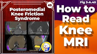 Fig 3A45 Posteromedial Knee Friction Syndrome [upl. by Anire]