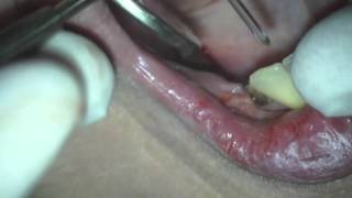 Implant Removal using Fotona Laser at Boynton Laser Dental Center [upl. by Odille649]