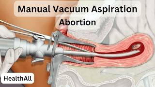 MVA Abortion The Procedure Explained [upl. by Acireh]