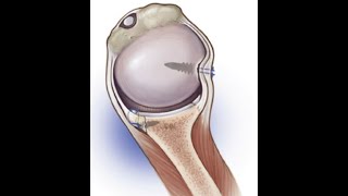 Arthroscopic Remplissage [upl. by Schmidt]