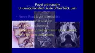 UCSF Radiology Facet Disease An underappreciated Cause of Lower Back Pain [upl. by Harday610]