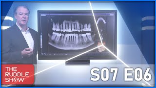 S07 E06  ExtraCanal Invasive Resorption Special Case Report by Dr Terry Pannkuk [upl. by Marchese]