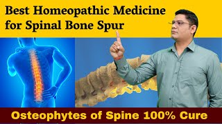 Best Homeopathic Medicine for Spinal Bone Spur Osteophytes of Spine 100 cure  Dr Sunil Patidar [upl. by Pattison]