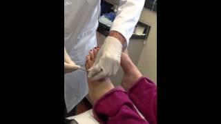 5th Metatarsal Pin Removal [upl. by Ebbie]