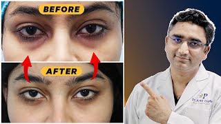 Eye Bags  Puffy Eyes Solution [upl. by Delos]