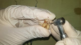 Management of deep caries using partial caries removal technique practical عربي [upl. by Skill]