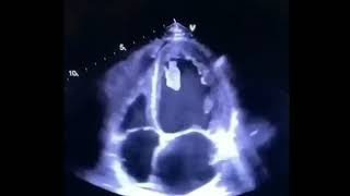 Large Cardiac embolus seen on echo [upl. by Rabin]