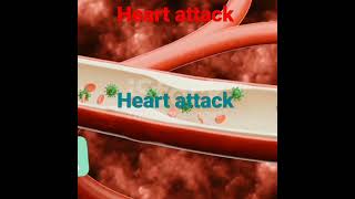 Heart attack 3d video myocardial infarction heart attack 3d animationmedical world official [upl. by Jacquet]