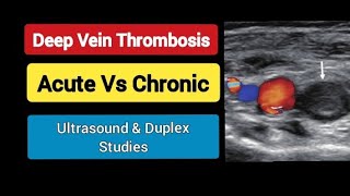 Deep Vein Thrombosis  Acute Vs Chronic  Ultrasound amp Duplex  Radiology [upl. by Araec145]