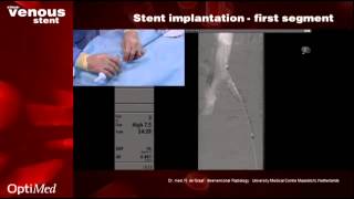 sinusVenous stent in practice [upl. by Vieva]