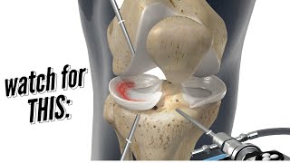 Meniscus Repair vs Meniscectomy [upl. by Eenahs]