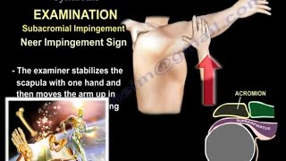 Shoulder Impingement Syndrome  Everything You Need To Know  Dr Nabil Ebraheim [upl. by Aisela]