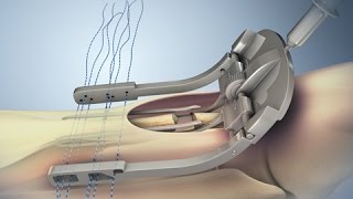 Achilles Tendon Rupture and Repair [upl. by Vanessa419]