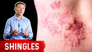 Why Is Everyone Getting Shingles [upl. by Immot]