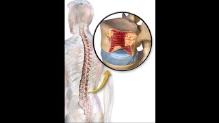 multiple bony lytic lesions [upl. by Mikael738]