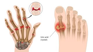 What is Gout Symptoms Causes Diagnosis Treatments [upl. by Adlev]