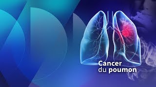 Le cancer du poumon chez les nonfumeurs [upl. by Ainola46]