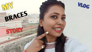 My Braces Journey My Braces Story 😊 ND Family Vlogs [upl. by Guinevere]