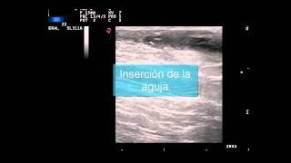 Infiltración de fístula ecodirigida en hidradenitis supurativa [upl. by Aserahs]