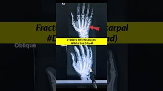 Fracture 5th Metacarpal ⚡️Xray Hand xray radiographerusn radiography shorts [upl. by Der]