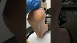 Watch a podiatrist tackle a stubborn callus Discomfort be gone 🦶🩺 PodiatryMagic [upl. by Ayama]