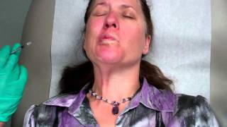 Botox Treatment for Bells Palsy [upl. by Keelby]