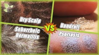 Dry Scalp vs Dandruff vs Seborrheic Dermatitis vs Psoriasis [upl. by Eirrot]