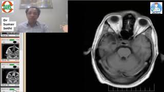 Gliosisencephalomacia by Dr Sumer Sethi [upl. by Ettevad]