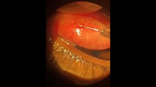 Management of Conjunctival Concretions [upl. by Shevlo428]