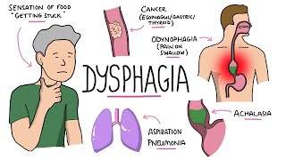 Dysphagia  Oropharyngeal amp Esophageal Dysphagia CausesDifferential Diagnosis Signs Treatment [upl. by Assele]