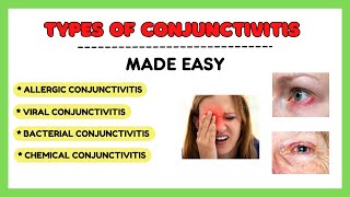 Types of conjunctivitis Allergic conjunctivitis Bacterial conjunctivitis Viral conjunctivitis [upl. by Elleinnad348]