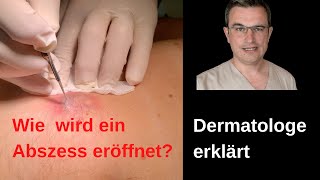 Dermatologe kommentiert Öffnen einer infizierte Zyste mit Abszess drkasten abszeß [upl. by Adnarram]