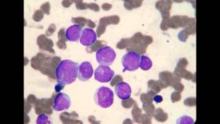 Acute Myeloblastic Leukemia M1 [upl. by Enelrats]