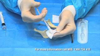 Bone Grafting simplified with BondBone by MIS [upl. by Alaine]