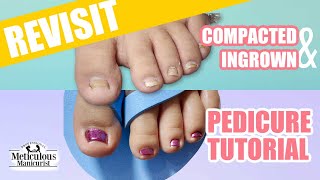 Revisiting the Deep Compacted Ingrown Toenail [upl. by Nickolaus]