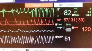 SVT adenosine brady VT SVT [upl. by Brink779]