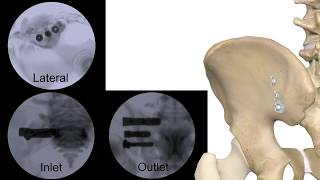 Corelink Entasis Sacroiliac Joint Fusion [upl. by Derreg]