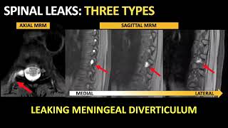 Cerebrospinal Fluid Examination CSF [upl. by Morgana]