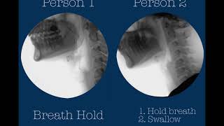 Swallowing postures and maneuvers with videofluoroscopy two healthy adults [upl. by Lynelle252]