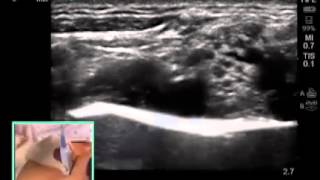 How to Ultrasound Guided Supraclavicular Brachial Plexus Nerve Block [upl. by Nirrat70]