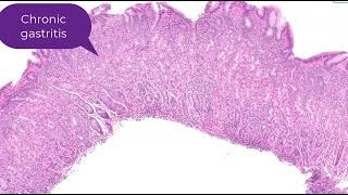 Collagenous gastritis in 90 seconds  Histology [upl. by Mohsen]