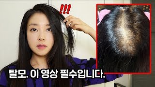 ENG 머리가 빠진다면 이 영상 꼭 보세요 탈모 극복하는법 완결판 How to overcome hair loss the complete guide  뷰티클라우드 유나 UNA [upl. by Darcie]